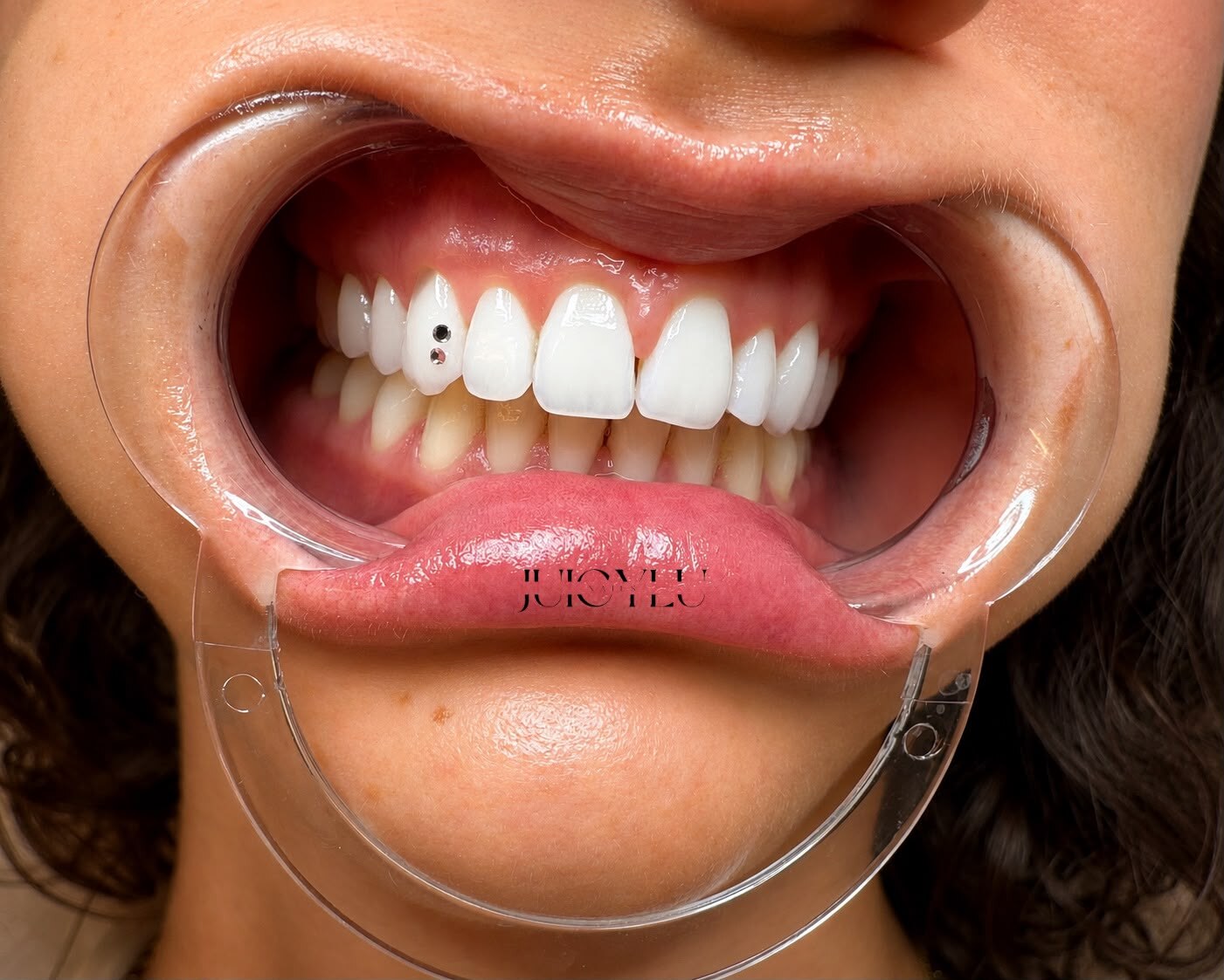 Präzise platzierte Tooth Gems während der Behandlung