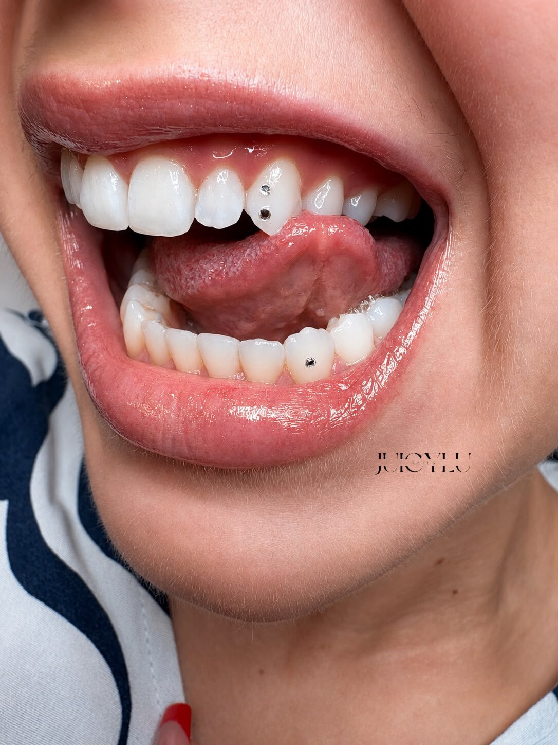 Tooth Gems auf oberen und unteren Zähnen